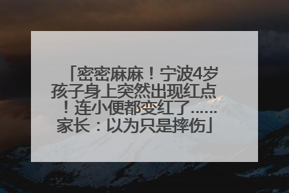 密密麻麻！宁波4岁孩子身上突然出现红点！连小便都变红了……家长：以为只是摔伤